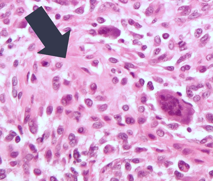 Osteoid